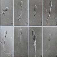Abnormal Sperms