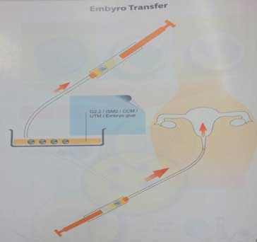 Embryo Transfer ET