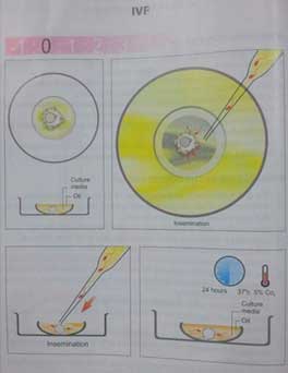 Insemination For In Vitro Fertilization (IVF)